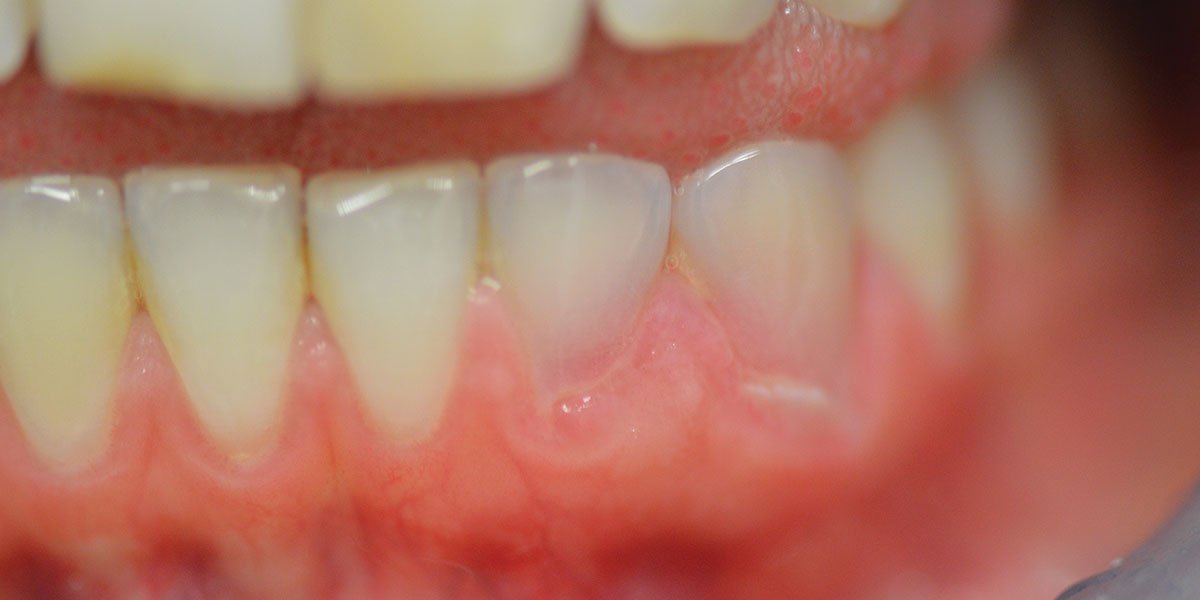 root resorption