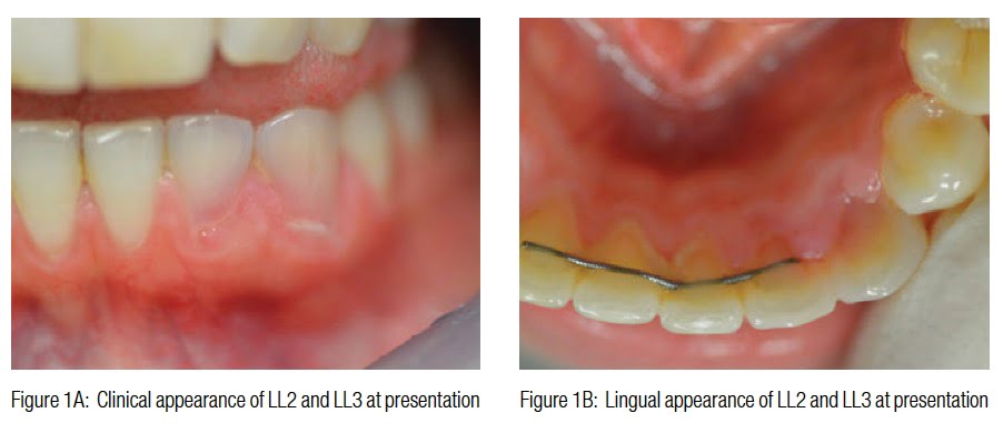 root resorption