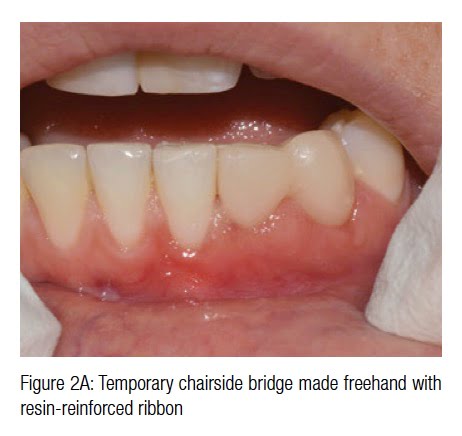 root resorption