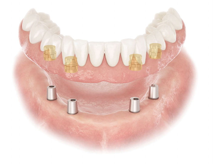 ATLANTIS Conus concept — a removable prosthesis with the comfort of a fixed restoration