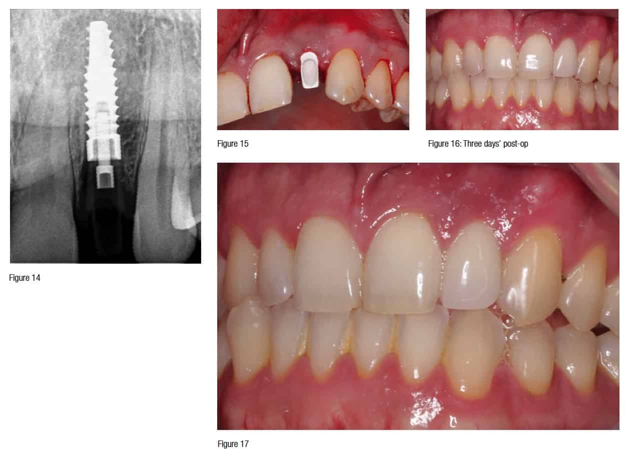 Guided surgical immediate implant placement with immediate load and CAD ...