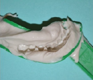 Figure 3: Alginate impression to be used for temporary fabrication