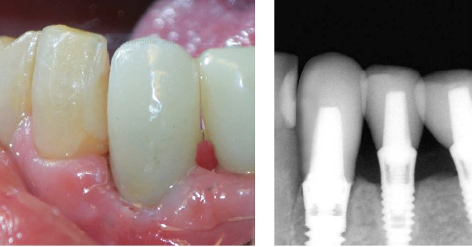 Left: Figure 21: Final restoration; Right: Figure 22: Final X-Ray