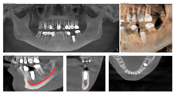 Figure 10: Postoperative CBCT of the implant planned in Figure 8 and placed using the surgical guide in Figure 9. There is no clinically significant difference between the planned and actual fixture placement
