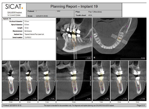 Figure 8: A digital treatment plan from the CBCT scan allows identification of the mandibular nerve and facilitates treatment planning based on anatomy and the final restoration