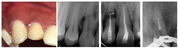 Figure 1: Trauma area 13, 12, and 11; Figure 2A; Figure 2B; Figure 3: MTA placed. Note: Figures 2A and 2B: Radiograph at 3 months post-trauma