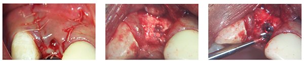 Figure 14: Sutured carefully with 5.0 Vicryl; Figure 15: Flap raised at 3 months to show new bone and some remnant graft material (less than 15%); Figure 16: Round bur used to remove excess bone