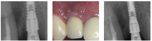 Figure 20: Abutment fitted — note new bone level; Figure 21: Six months loaded showing retention of profile; Figure 22: Six months loaded with further improved bone levels