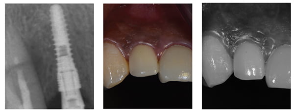 Figure 23: Radiograph at 1 year loaded — further bone improvement even in sites adjacent the canine; Figure 24A; Figure 24B. Note: Figures 24A and 24B: After 1 year of loading — needs more oral hygiene care.