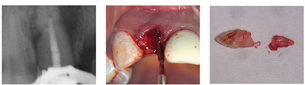 Figure 4: Completed root canal; Figure 5A; Figure 5B. Note: Figures 5A and 5B: Use of periotome to remove the root tip