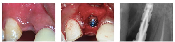Figure 9: But also showing hard tissue loss; Figure 10A; Figure 10B. Note: Figures 10A and 10B: Implant (DIO 3.8 mm x 12 mm) placed palatally, with site-specific flap retaining papillae