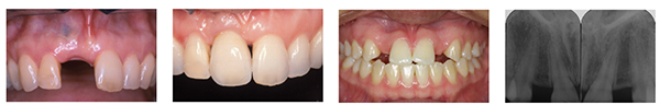 Figure 16: Excessive mesiodistal space in the region of the tooth requiring an implant restoration; Figure 17: Implant restoration in the region of the right central incisor. Note absence of interdental papilla as a result of inadequate support of the soft tissue by the restoration; Figure 18: Clinical presentation of patient with congenitally missing maxillary lateral incisors post orthodontic treatment; Figure 19: Radiograph of patient in Figure 18 revealing that there is insufficient interradicular space for implants