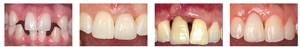Figure 20: Biotype 1 periodontium, note thin and scalloped tissue; Figure 21: Biotype 2 periodontium, not thick and flat tissues. Implant provisional restoration in the position of left central incisor; Figure 22: Loss of interproximal soft tissue in the presence of a triangular tooth form can result in unsightly black triangles; Figure 23: Over contour of the implant restoration as it emerges from the free gingival margin can result in apical migration of the soft tissues