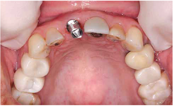 Figure 10: An impression post was attached to the implant so the final impression could be taken