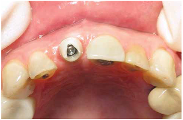 Figure 12: The Inclusive Zirconia Custom Abutment provided optimal support for the soft tissue and was essential in establishing a natural emergence profile for the final restoration