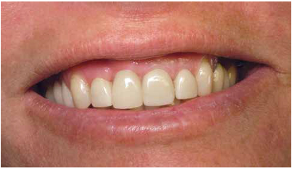 Figure 13: The final restoration of tooth No. 8 exhibited ideal gingival margins and improved upon the esthetics with which the patient presented for treatment. To further improve the outcome and establish consistency in the smile zone, tooth Nos. 7, 9, and 10 were prepared and restored with new BruxZir Anterior crowns.