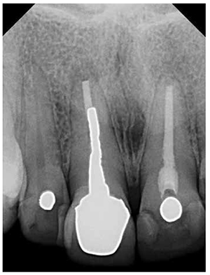 Figure 2: Radiographic evaluation revealed plenty of bone apical, mesial, and distal to the non-restorable tooth. Note how the post connecting the crown to the root canal had broken in half