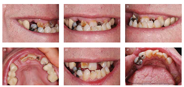 Figures 2A-2F: Preoperative photographs. 2A: Right view. 2B: Upper arch. 2C: Smile line. 2D: First occlusal contact in centric. 2E: Left view. 2F: Lower arch