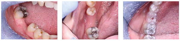 Figure 2: Preoperative photo of LR6 area; Figure 3: Preoperative photo of LR6 – occlusal view; Figure 4: Surgical stent in place