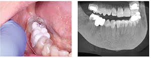 Figure 5: Radiographic stent; Figure 6: CBCT scan