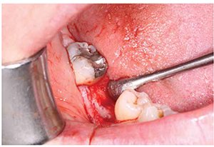 Figure 7: Post incision – flap raised, exposing the full extent of the ridge