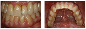 Figure 16D: Left lateral view of the ISFD definitive prosthesis in CR; Figure 16E: Occlusal view of the ISFD definitive prosthesis