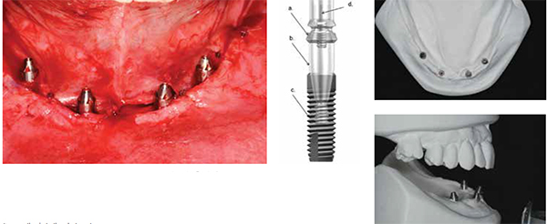 Figures 7A-7B: 7A. Conical interface abutments (Uni Abutments, Dentsply Implants) hand torqued in place at the time of implant surgery. Note that the 4 mm length makes access to the restorative interface directly accessible. The angular correction necessary is provided by the 20º interface design. 7B. Schematic drawing reveals the construction of components using conical seal design abutments (b) within the 4.0 mm implant (c). The 4 mm abutment easily traverses the 2 mm-3 mm of mucosa and reveals a circular interface that supports the 20º interface for the bridge cylinder (a).The bridge screw (d) attaches the prosthesis to the abutment; Figures 8A-8B: 8A. Occlusal view of the mandibular master cast incorporating the 20º conical interface analogues. 8B. Right lateral view of the mounted master cast. Note the angulation of the abutment accounts for the intended nonparallel nature of the implant orientation
