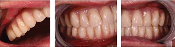 Figures 14-16: No more gaps or space between the restoration and soft tissues