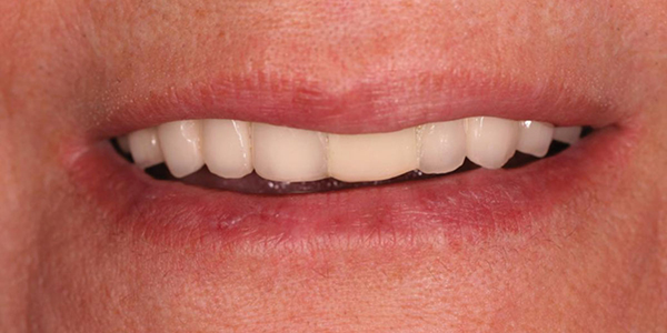 Figure 1: Extraoral appearance during smiling (when the patient presented to us)