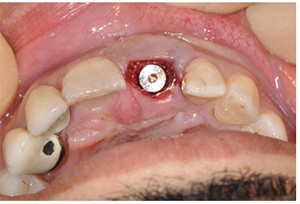 Figure 10: Implant placed