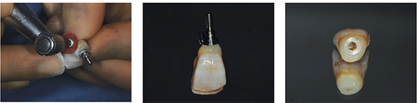 Figure 24: Abrasive discs used to shape and polish resin to cementum interface; Figure 25: Submergence profile complete; Figure 26: Removed from duplicate abutment, ready to seat