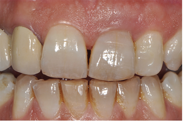 Figure 32: Note significant improvement in gingival health and color