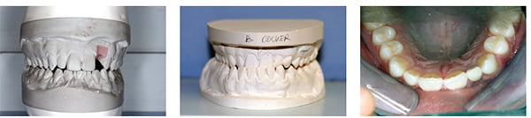 Figures 11-12: Working casts in Figure 11 are not sitting in the correct Class III bite that is shown in the final casts in Figure 12; Figure 13: Postoperative photo 2 years after implant therapy