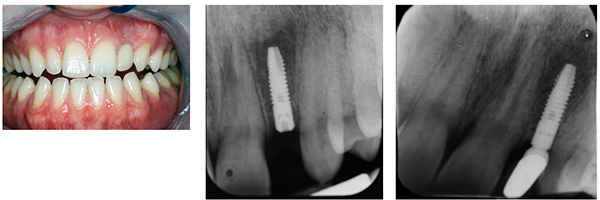 Figure 14: Note the more balanced incisal lengths; Figure 15: The postoperative X-ray taken March 8, 2011; Figure 16: The postoperative X-ray taken May 13, 2013