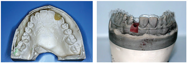 Figure 7: Photograph showing the pre-op wax-up; Figure 8