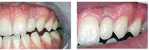 Figures 9 and 10: Cement-retained UL2 implant crown in situ
