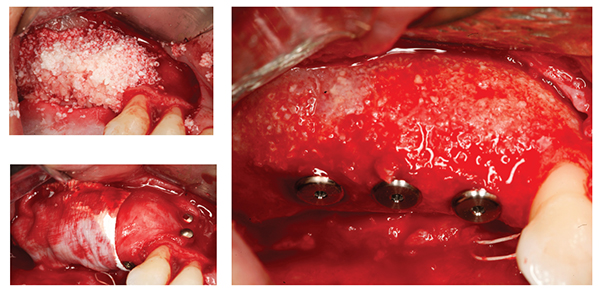 Figure 3: Application of the bone graft particles; Figure 4: The membrane is applied and secured using fixation pins; Figure 5: View of the augmented bone crest with three implants in position