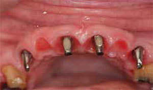 Figure 12: Intraoral view of the abutments on completion of soft tissue healing. The contours developed by the transitional restoration are visible. Note that the abutments lie within the prosthetic envelope and are aligned to each other