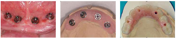 Figure 14: Four abutments, attached to implants in the interforaminal region, can be seen. Impressions of these are taken using the open-tray technique, the accuracy verified, and master cast constructed; Figure 15: The master cast with abutment analogs is visible. This has been constructed from a verification jig. This will be scanned along with the diagnostic preview. Both the master cast and the diagnostic preview will be sent to the scanning center; Figure 16: The diagnostic preview will be sent to the scanning center along with the master cast. The scanned data will then be used to construct the metal (chrome-cobalt) framework