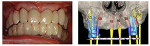Figure 8: Showing the transfer of information from the diagnostic preview to the mouth in the form of a provisional metal-acrylic bridge, supported by selected teeth. Note the change in tooth position and intermaxillary relationship; Figure 9: Cone beam CT scan. Interactive planning using the SIMPLANT software showing the positioning of the implants within the available bone as well as the selection of the abutments, which lie within the prosthetic envelope