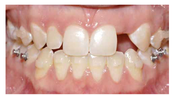 Figure 1: Surgical site No. 10 optimized orthodontically for implant placement