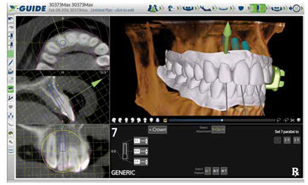 Figure 11: Virtual planning screen showing intraoral scan STL file superimposed on DICOM file for detailed treatment planning