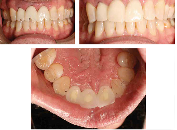 Figures 15A-15C: A. Splinted provisional PMMA acrylic restoration seated and screwed in place demonstrating the screw access through the restorations (Nextek Dental Studio). B. Composite placed to finish provisional sealing the screw access holes. C. Occlusal view showing absence of centric or protrusive contacts
