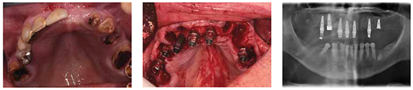 Figure 4: Maxillary arch after failure of Maryland bridge; Figure 5: Immediate implant placement in the maxilla; Figure 6: Postoperative OPG
