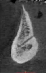 Figure 6: Cross section slice of mandible using the Carestream 8100