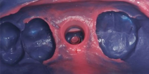 Figure 2: Impression of tooth No. 3 with light body and heavy body polyether impression material (Impregum™ Soft Quick Step, 3M)