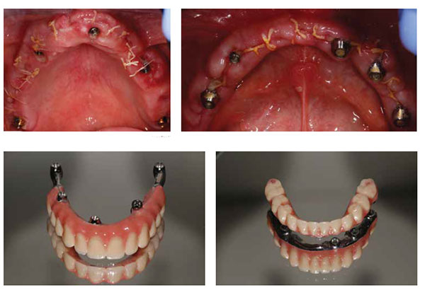 Figure 8: Clinical situation at 7 days following placement and provisionalization; Figure 9: The final metal-acrylic restoration