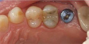 Figure 1: Preoperative view of tooth No. 3