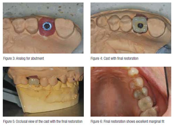 Figure 3: Analog for abutment; Figure 4: Cast with final restoration; Figure 5: Occlusal view of the cast with the final restoration; Figure 6: Final restoration shows excellent marginal fit