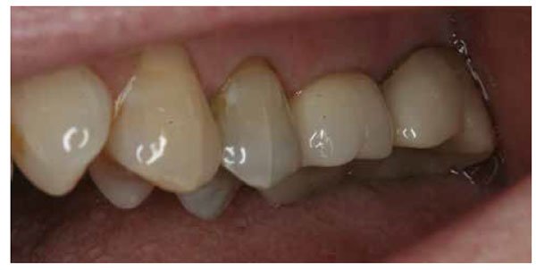 Figure 7: Final seated restoration on tooth No. 3
